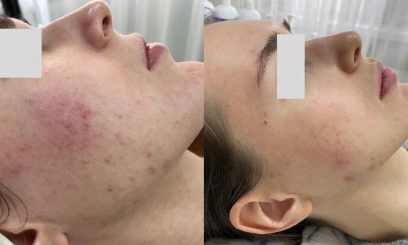 Уход-чистка  Голливудская чистка ZO Skin health от Zein Obagi